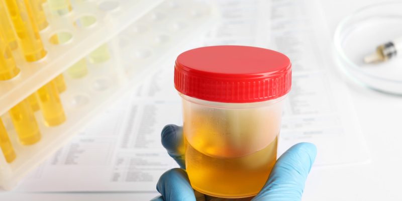 Nurse,Holding,Container,With,Urine,Sample,For,Analysis,At,Table,